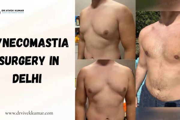 Gynecomastia Surgery in Delhi – Regain Your Confidence with Sculpt India Gynecomastia surgery in Delhi