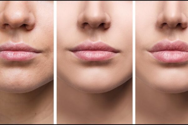 Lip Flip in Novi: What to Know Before You Book Your Appointment Lip Flip in Novi – Subtle Lip Enhancement & Quick Botox Procedure